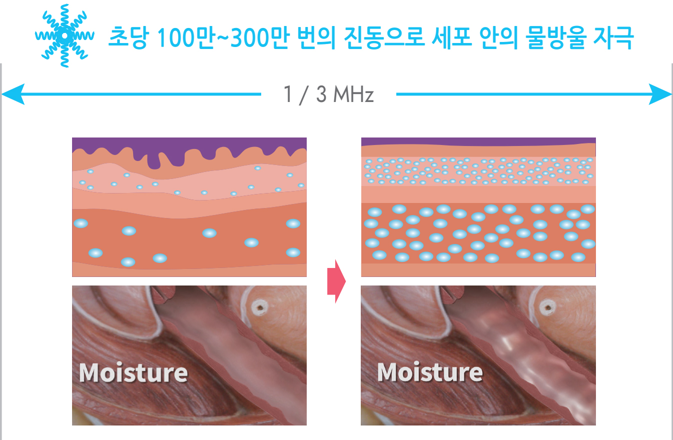 초당 100만~300만 번의진동으로 세포안의 물방울 자극